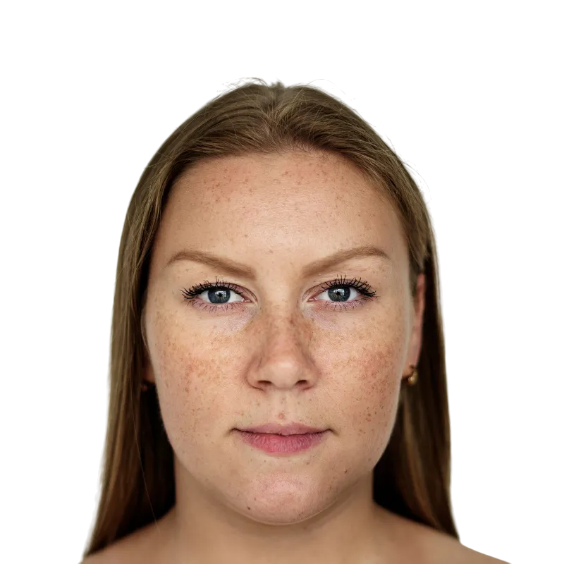 melasma