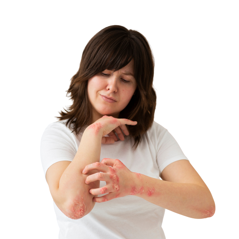 psoriasis